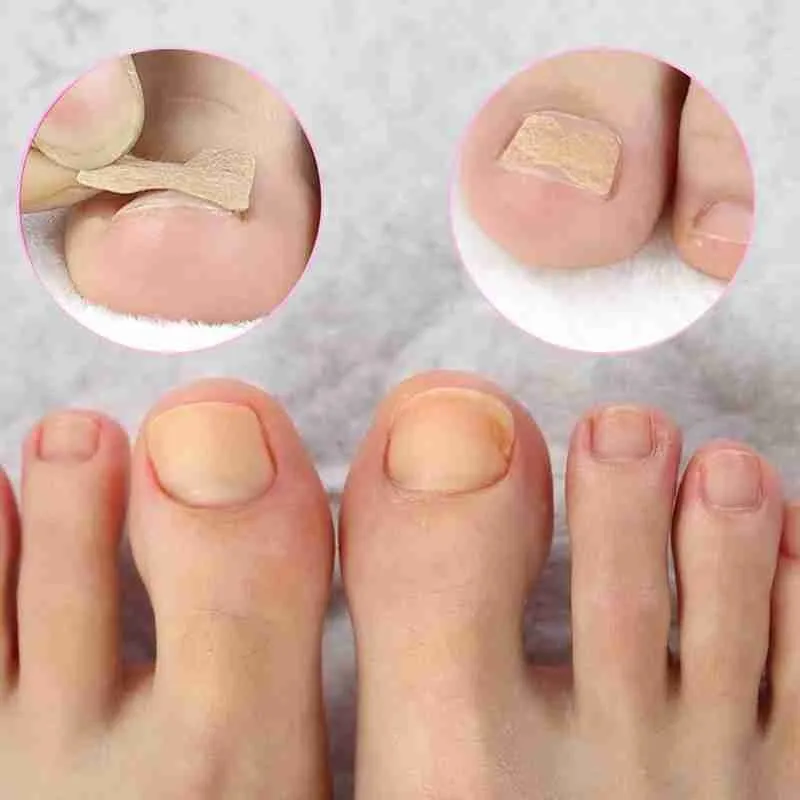 Glue Free Toenail Patch